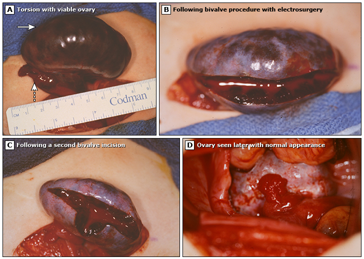 Ovarian and fallopian tube torsion - UpToDate