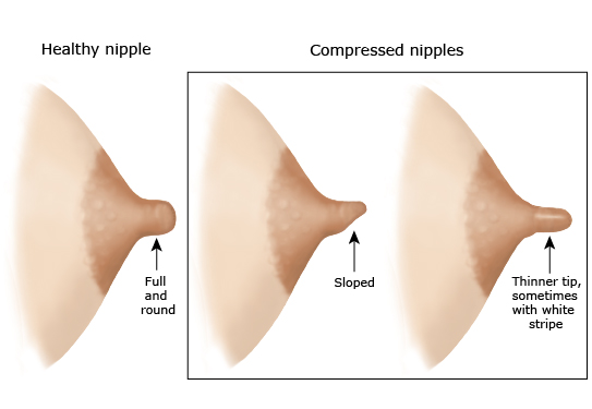 Nipples - Physician Guide to Breastfeeding