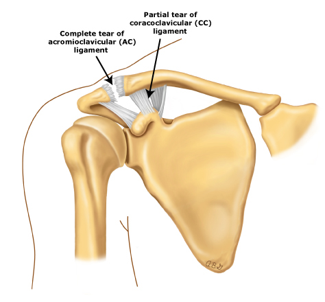 Patient education: Acromioclavicular joint injury (shoulder separation)  (Beyond the Basics) - UpToDate