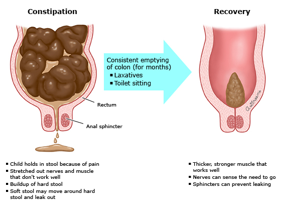 Constipation In Infants And Children