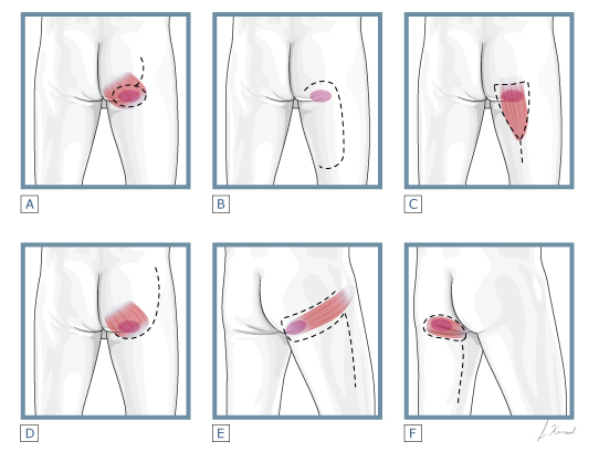 How to prevent pressure ulcers on the buttocks? - O Neill Healthcare
